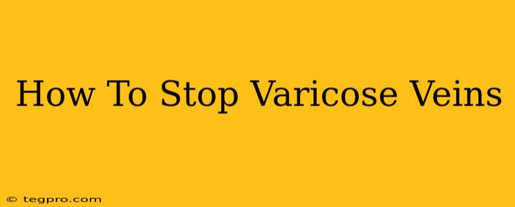 How To Stop Varicose Veins